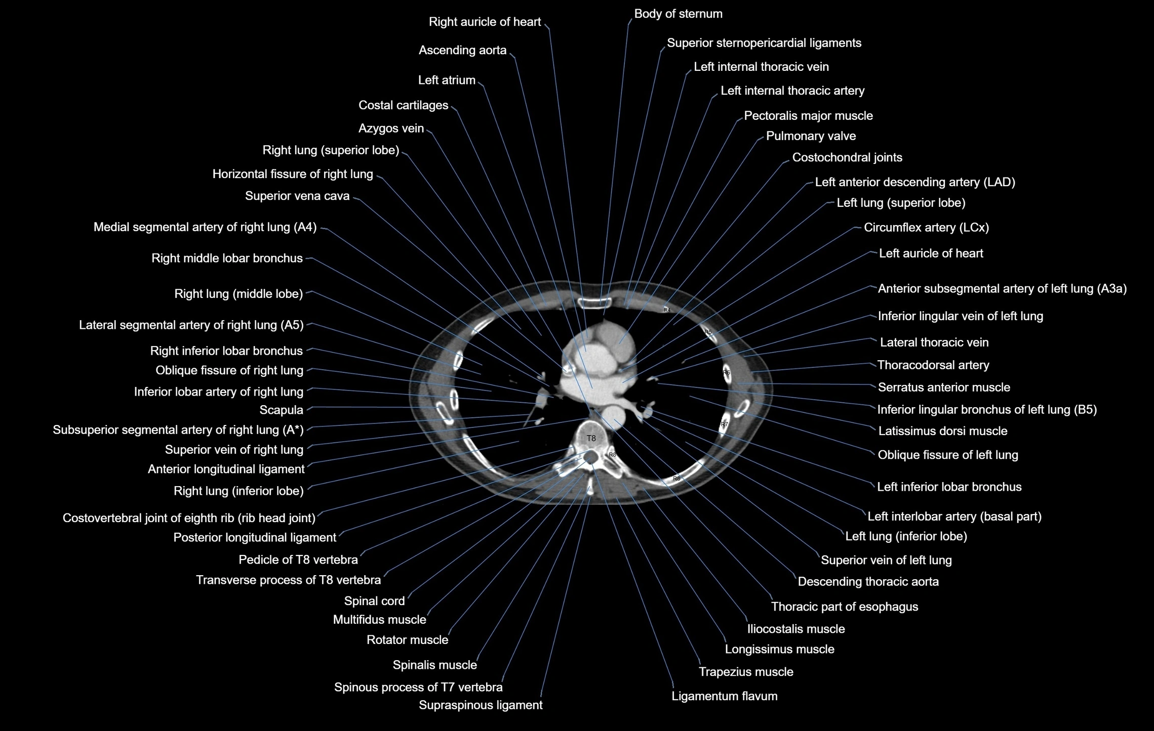 CT chest (thorax) soft tissue window labelled axial cross sectional anatomy radiology image-00066.webp